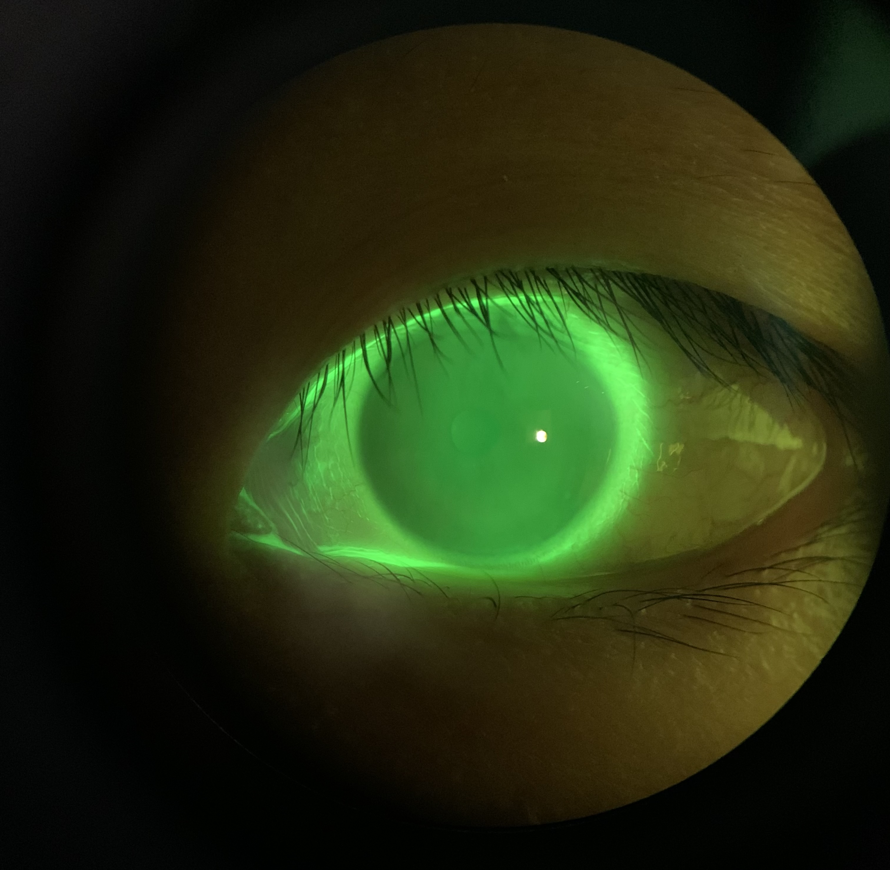 is-orthokeratology-safe-emme